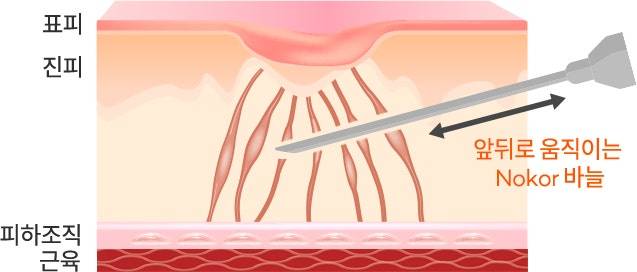 subcision
