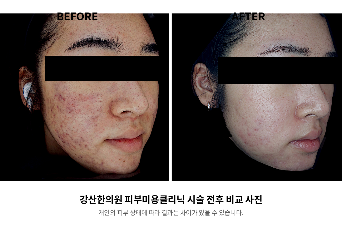 강산한의원 피부미용클리닉 시술 전후 비교 사진